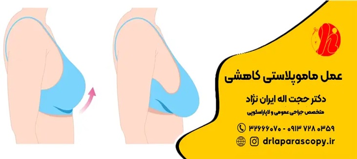 ماموپلاستی در اصفهان