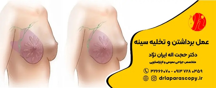 ماموپلاستی در اصفهان