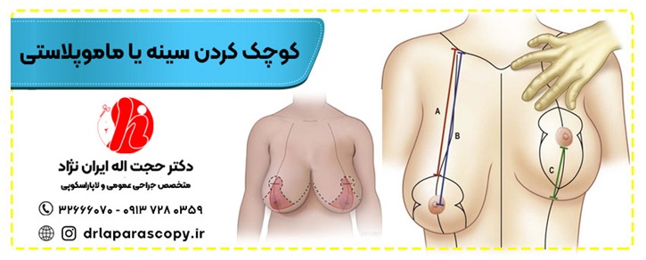 ماموپلاستی در اصفهان
