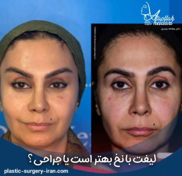 مقایسه انواع روشهای لیفت صورت و بهترین آن + مزایا و عوارض