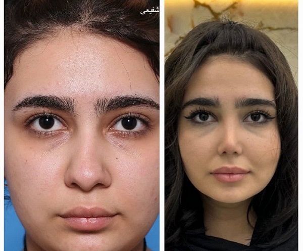 جراح بینی در تهران با قیمت مناسب