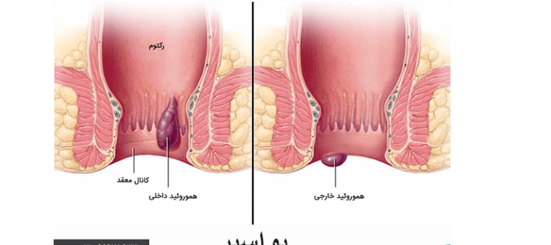 اصلی ترین علت های بروز هموروئید که از آنها بی خبرید !
